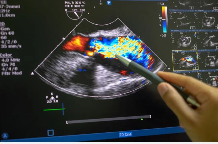 Colour Doppler